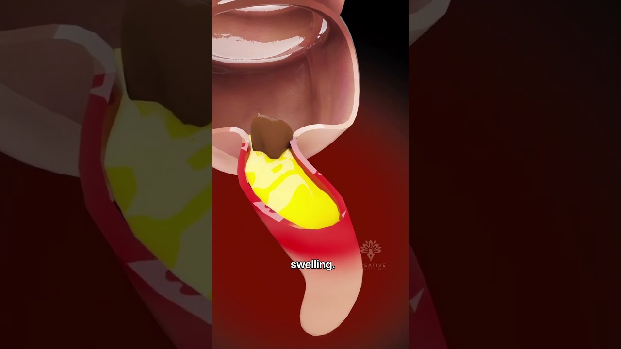 How Appendicitis Happens Appendix Symptoms Shorts Creativelearning3d
