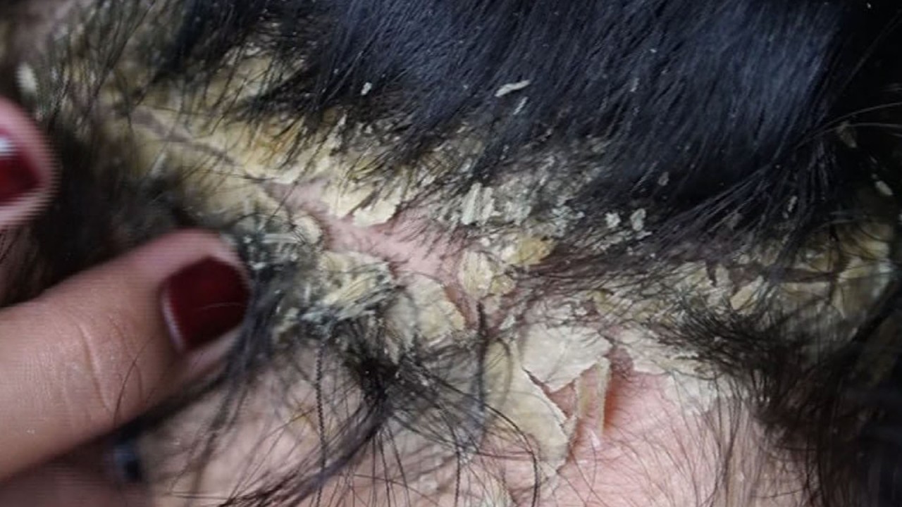 relaxing Treatment and Dandruff Removal Scratching#21