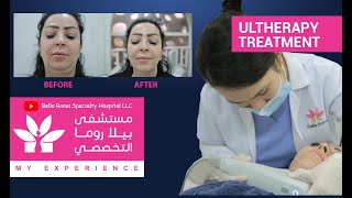 Ultherapy Treatment in Bella Roma Dubai