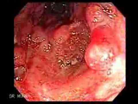 Colonoscopy  of Ulcerative Colitis with Pseudopolyps