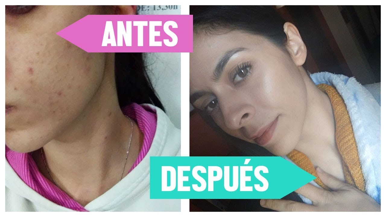 resultados-del-dermaroller-eliminar-el-acne-y-estr-as-antes-y