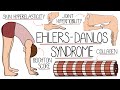 Ehlers Danlos Syndrome Explained Clearly