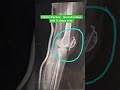 Patella Fracture Surgery: An X-Ray Guide to 8-Shaped Wire Techniques