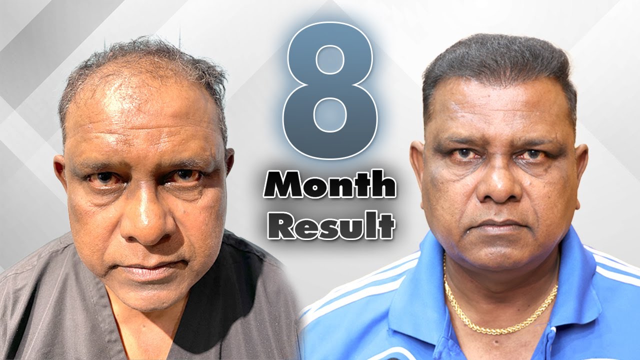 3500 Grafts In 57 Years Age | Hair Transplant Results Month by Month | FUT vs FUE scars in DONOR!