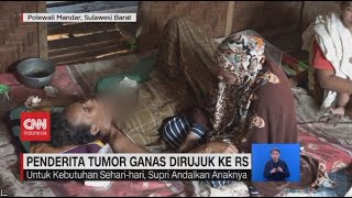 Penderita Tumor Ganas Dirujuk Ke RS