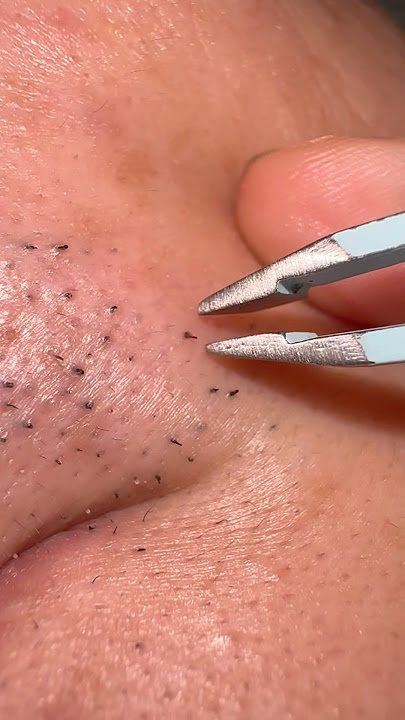 Simple Daily Beard Grooming Routine#hairremoval #tweezers #plucking #roblox #satisfying