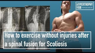 Science based scoliosis spinal fusion exercise recommendations.