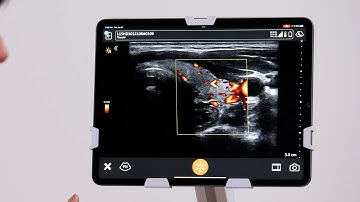 Power Doppler Imaging