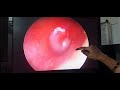 Otitis Media ( કાન ના પડદા મા સોજો )