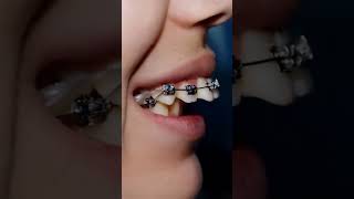 Teeth Braces Transformation | Before &amp; After Smile Makeover| Teeth Braces பற்கள் சீரமைப்பு பிரேஸ்ஸ்