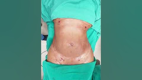 360° Abdomen Liposuction Before and After