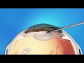 Phaco Refractive Lens Exchange