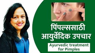 चेहऱ्यावरील पिंपल्स जाण्यासाठी आयुर्वेदिक उपचार | ayurvedic treatment for acne scars in marathi