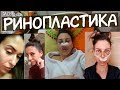 СДЕЛАЛА РИНОПЛАСТИКУ 👃 НОВЫЙ НОС / Сколько стоит ринопластика 💲 Как Я РЕШИЛАСЬ / риносептопластика