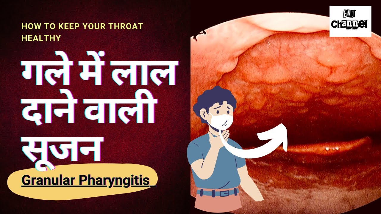 Granular pharyngitis Gale me Lal daane hona गले में लाल दाने वाली