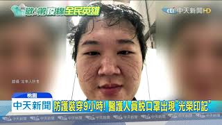 20200320中天新聞　防護裝穿9小時！　醫護人員脫口罩出現「光榮印記」