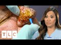 Dr. Lee Transforms Patient's Hugely Overgrown Nose I Dr. Pimple Popper: Pop Ups