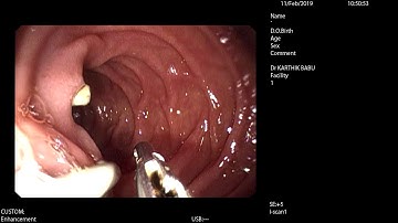 endoscopic cbd stent removal