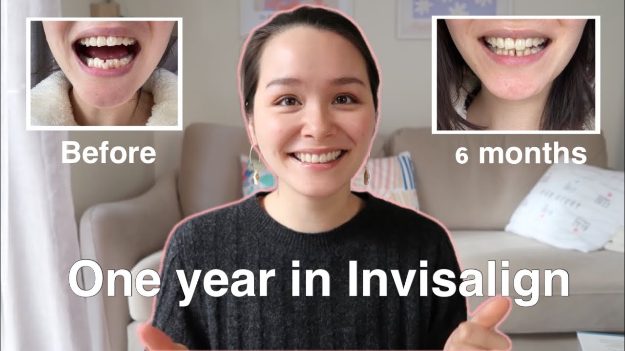 One Year Invisalign One year in Invisalign update! - YouTube