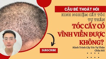 TÓC CẤY TỰ THÂN CÓ DUY TRÌ VĨNH VIỄN ĐƯỢC KHÔNG? l KINH NGHIỆM CẤY TÓC TỰ THÂN