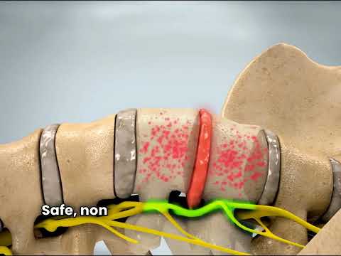 See it explained — CBP Precision Spine Center