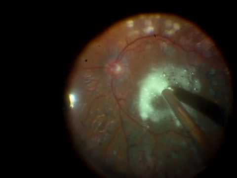 This is a case of a patient with diabetic retinopathy with macular edema and epiretinal membrane secondary, underwent cataract surgery and peeling of epiretinal membranes with improved vision