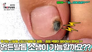 멍든발톱... 소생이 가능할까요?? 꽉 끼는 신발 잘못신어서 변색되는 발톱ㅠㅠ 이게 되네??💛 #레푸스 #refuss #내성발톱 #무좀발톱 #발톱 #toenails #내성