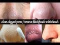 How To Clean Clogged Pores | How to get rid of blackheads and Whiteheads