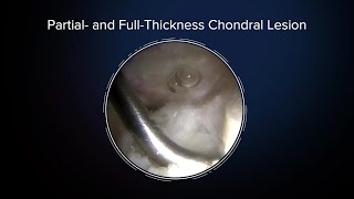 AutoCart™ Technique for an Acetabular Chondral Injury
