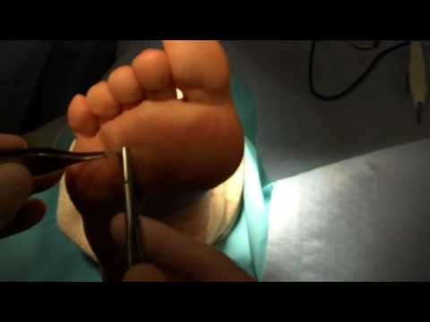 Dr. Patrick A. DeHeer, DPM - Excision of Morton's Neuroma