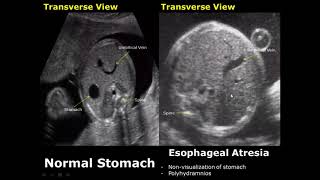 Fetal Stomach Ultrasound Normal Vs Abnormal Image Appearances | Fetal GIT USG Abnormalities