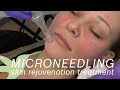 Microneeding demo  skin by lovely