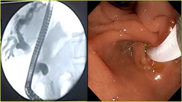 Cholangiocarcinoma ERCP Metallic Stent Placement #BD_ENDOSCOPY