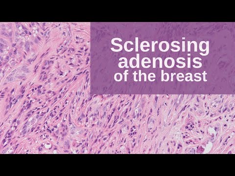 स्तन के स्क्लेरोज़िंग एडेनोसिस - पैथोलॉजी मिनी ट्यूटोरियल