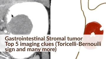 Gastrointestinal Stromal Tumor: Top 5 imaging Clues