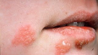 هل تعاني من حمى الفم أو حبوب الحرارة استعملو ZOVIRAX CRÈME