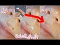 وصفة للقضاء على الشامات وازالتها كأنك أزلتها بعملية دون ترك علامتها قولي وداعا للشامات
