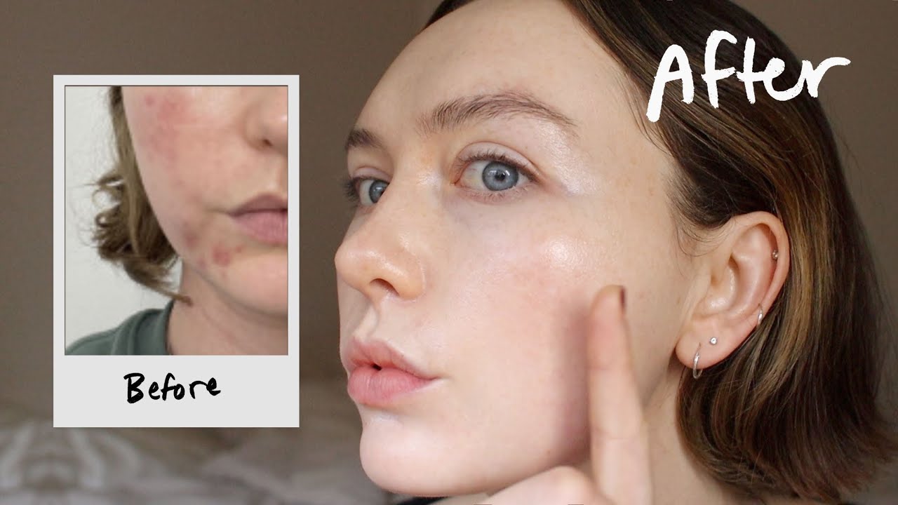 I tried Tretinoin for 6 months—the most potent skincare?