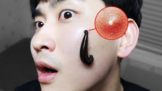 Leech Bites My Face! (acne self treatment )