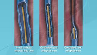 Fort HealthCare Venous Closure Discussion - Episode 3 - Overview of VNUS ClosureFast™ procedure