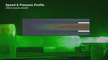 V02-01: The Vortex Effect in mini-PCNL