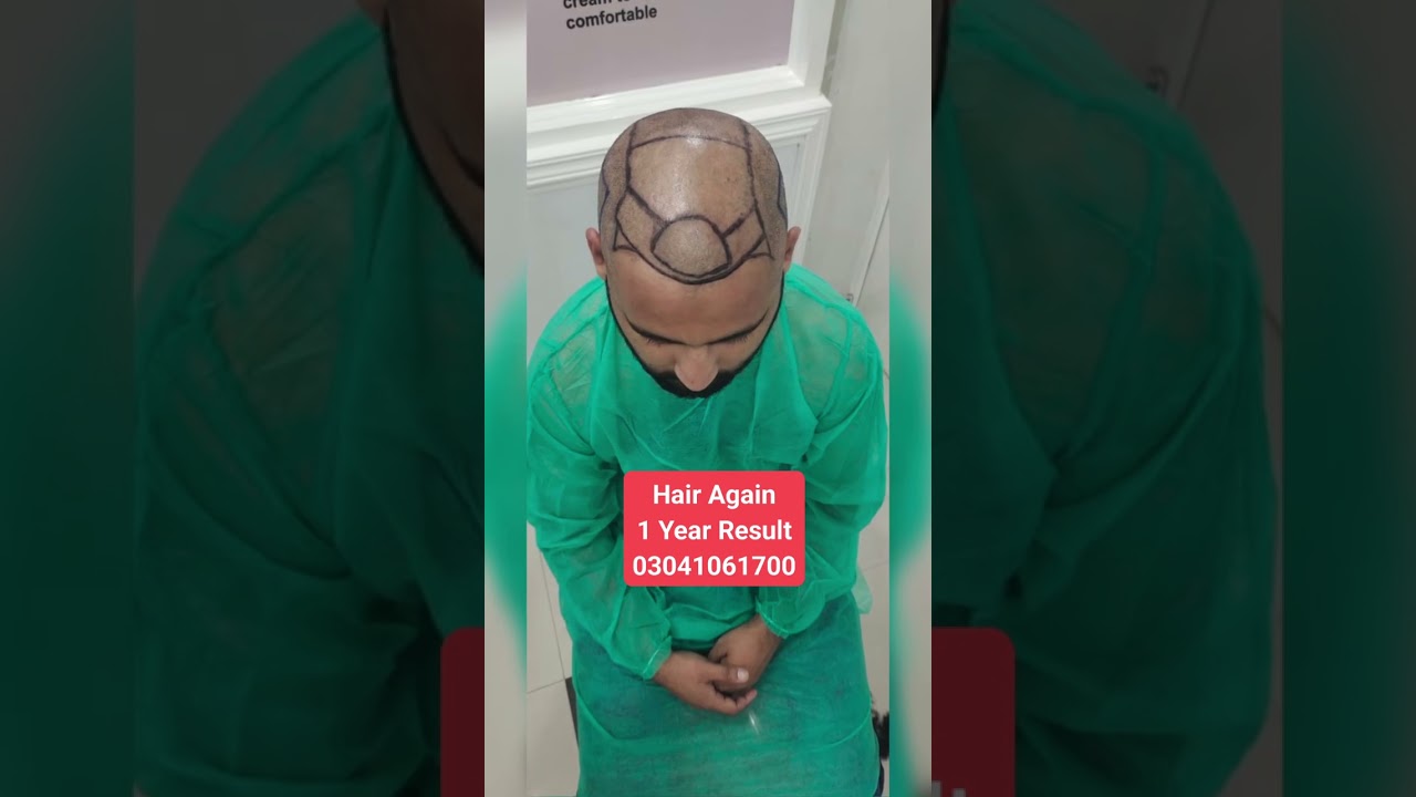 Hair Again FUE Hair Transplant Surgery in Lahore Sargodha Islamabad Pakistan 03041061700