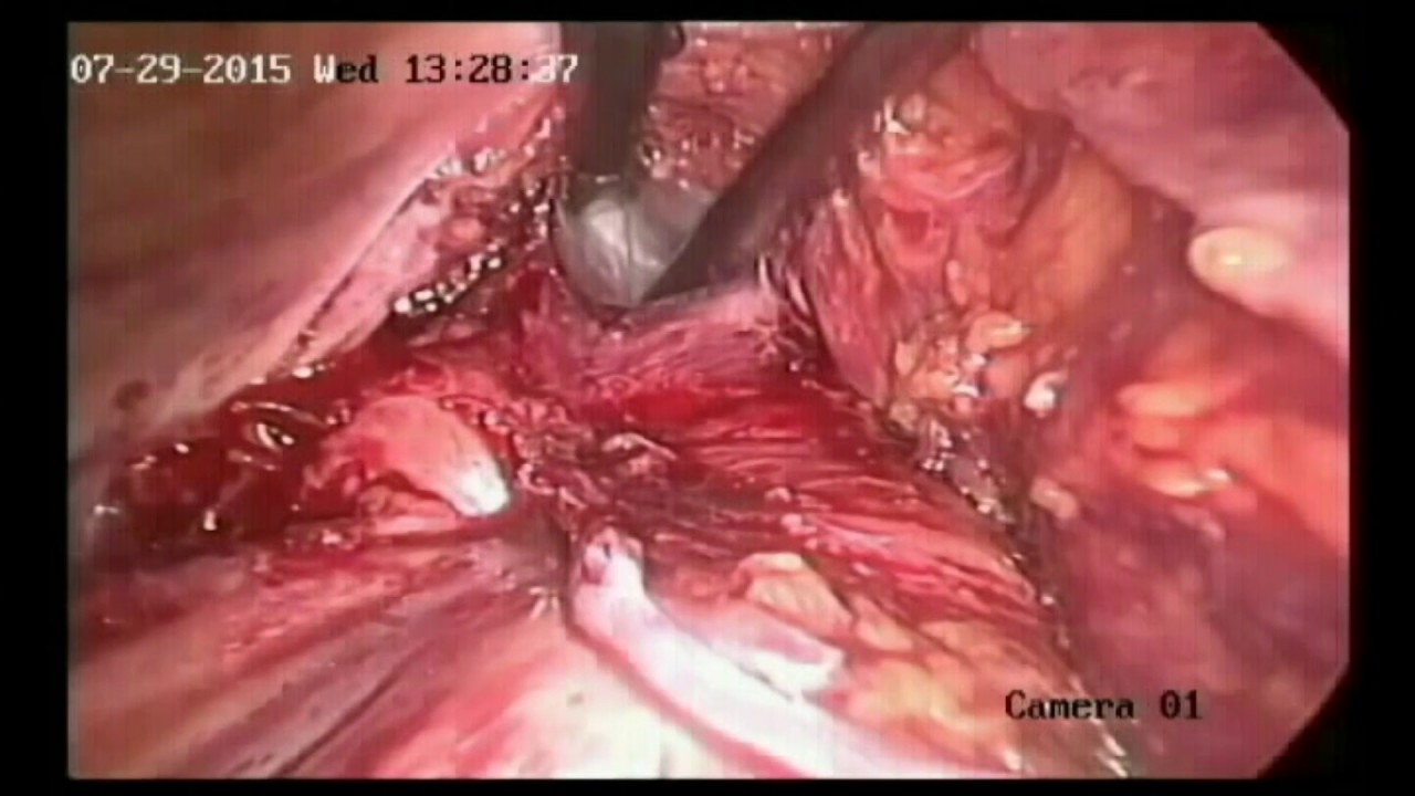 laparoscopic low anterior resection , rectal cancer video editing software free