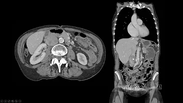 O que é um leiomiossarcoma?