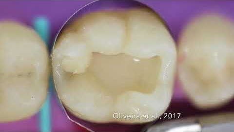 Classe II Bulk Fill Flow