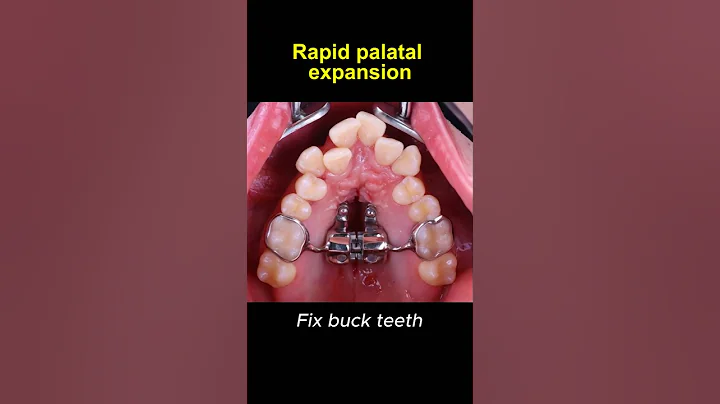 Expand upper teeth with rapid palatal expander #braces #orthodontist #dentist