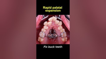 Expand upper teeth with rapid palatal expander #braces #orthodontist #dentist