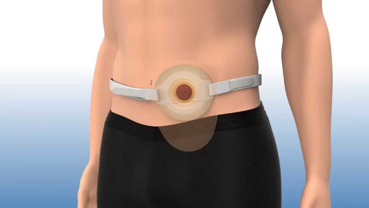 Ostomy belt - Welland Medical