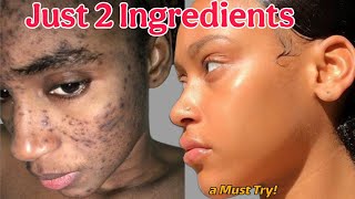 How I Brightened My dull skin using simple home remedy..I Bet you have not tried it #acne #skincare