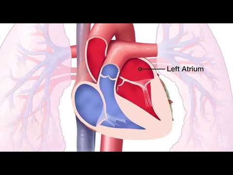 Videó: Mitralis regurgitáció diagnosztizálása: 15 lépés (képekkel)